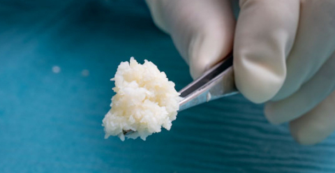 Kerecis® Omega3 MicroGraft is intact fish skin divided into fragments, which mold into wound beds. (Photo: Business Wire)