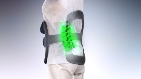 Illustration of the Orthofix SpinalStim Bone Growth Therapy device for patients recovering from lumbar fusion surgery. (Photo: Business Wire)