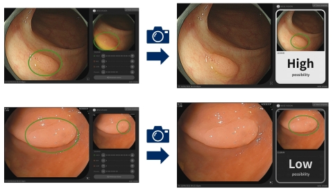 The Cx20 function supports the identification of disease: During examinations, suspected lesions are automatically detected through video taken by endoscope devices. Doctors then extract still images (left) and analysis results are soon displayed (right) (Graphic: Business Wire)