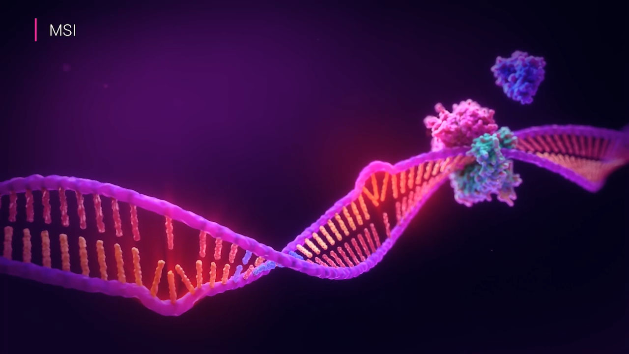 Microsatellite instability (MSI) is a form of genomic instability caused when too many or too few repeating bases, called microsatellites, occur during DNA replication and the body’s mismatch repair system fails to correct these errors. MSI status is used to screen for Lynch syndrome.