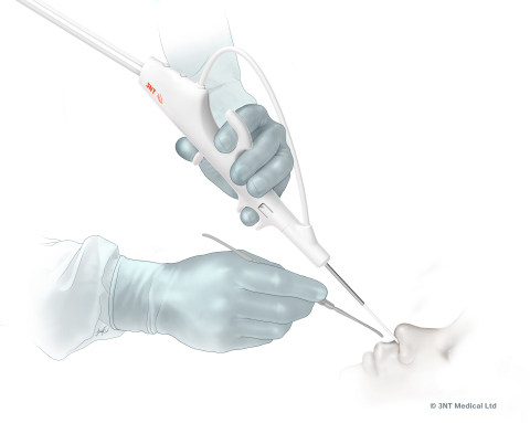 The Peregrine™ Drivable ENT Scope provides ENT surgeons with access to the furthest reaches of the sinuses to visualize anatomic landmarks up-close both intra- and post-operatively, with excellent image quality, minimal resection, and single-handed operation. (Graphic: Business Wire)