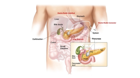 ACT-IOP-003 Pancreatic Cancer drug delivery system (Photo: Business Wire)