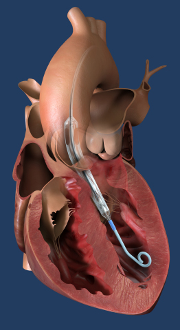 Impella ECPは世界最小の心臓ポンプで、左室へと経皮的に挿入され、拡張して心臓のポンプ機能を補助し、3.5 L/min以上の流量を提供。（写真：ビジネスワイヤ）