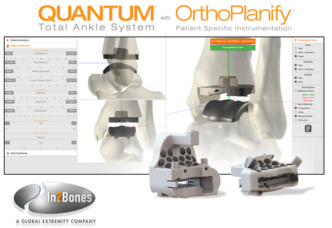 In2Bones’ Orthoplanify software integrates patient CT scans and X-rays, enabling surgeons to easily modify, adjust, and manipulate placement of the QUANTUM Total Ankle System implant prior to surgery. During surgery, the Total Ankle System’s custom 3D-printed cutting guides save surgeons multiple steps and allow for precision bone cuts and more accurate implant alignment when compared with manual instrumentation. (Graphic: Business Wire)
