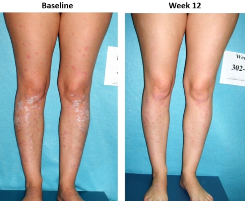 Image from prior Phase II clinical trial of Piclidenoson of patient’s skin before treatment and at week 12 following treatment (Photo: Business Wire)