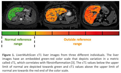 New study finds Perspectum’s LiverMultiScan may positively impact ...