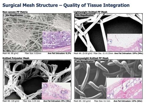 thumbnail Non-woven SURGIMESH: Significantly reduced post-operative chronic pain (Graphic: Business Wire)