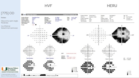 The study, which compared the HFA to re:Vive by Heru, found strong correlations between Heru’s and HFA’s visual field mean deviation and threshold values in normal eyes and eyes with glaucoma and other pathologies. (Graphic: Business Wire)