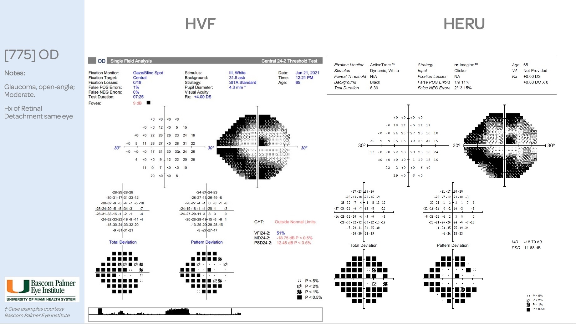 Visual Field Computerixe Computerized Visual Field Testing - PablorosCole