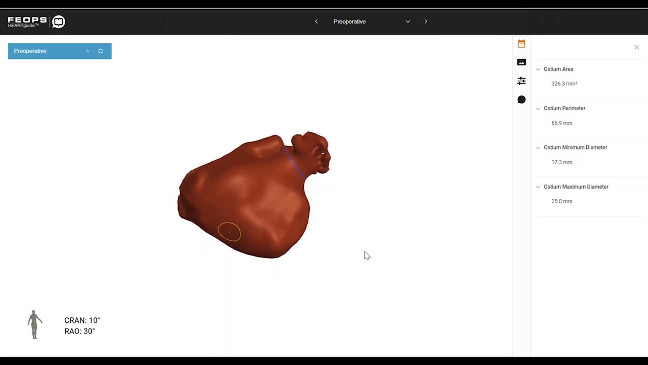 FEops HEARTguide authorized by FDA for unprecedented LAAo planning capabilities