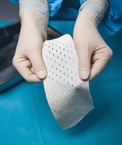 Kerecis® Omega3 SurgiBind™ is an implantable fish-skin graft for use in plastic and reconstructive surgery. (Photo: Business Wire)