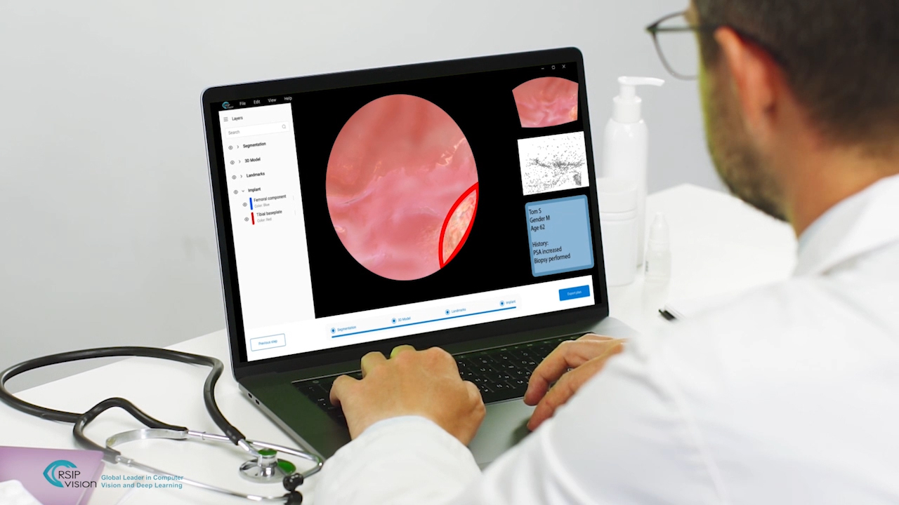 RSIP Vision's Bladder Panorama Generator and Sparse Reconstruction Tool automatically performs accurate stitching of cystoscopy images of the bladder to create a large panoramic image.