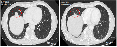 Figure 1: stable disease in a pancreatic cancer patient with lung metastasis which initially increased in size to 270mm2 and then subsequently stabilized at 100mm2 after three months of treatment with KiroVax/BSK01 in combination with chemotherapy (Photo: Business Wire)