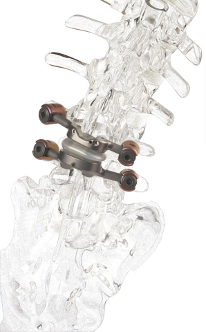The first and only facet joint replacement system for the lumbar spine, Premia Spine's TOPS System was developed to provide mobility, stability and durability after decompression for patients with lumbar spinal stenosis and degenerative spondylolisthesis. (Photo: Business Wire)