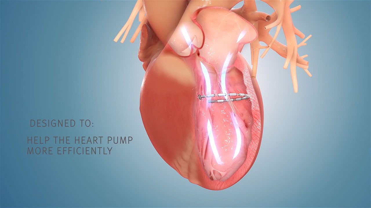 Ancora Heart's  proprietary AccuCinch® Ventricular Restoration System is the only completely transcatheter device designed to restore the structure and function of the enlarged left ventricle of the heart, thereby addressing the fundamental issue in the progression of heart failure in patients with reduced ejection fraction (HFrEF).