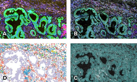 The CosMx SMI dataset contains a protein morphology map (A), a subcellular expression map of 960 genes (B), cell segmentation (C), and a spatially-resolved cell type map (D) of non-small cell lung cancer tissues. (Photo: Business Wire)