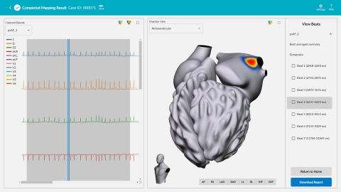 vMap™ is the first rapid, non-invasive arrhythmia-source mapping system designed to identify arrhythmia hot spots anywhere in the heart in minutes using only a 12-lead ECG. (Graphic: Business Wire)