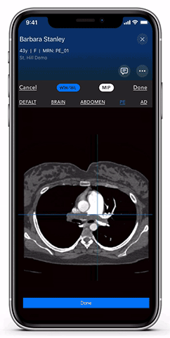 Diagnosis and care coordination of patients suffering from pulmonary embolism (PE) can be challenging, with the average arrival-to-treatment times lasting more than 8 hours. Viz.ai uses deep learning to identify suspected pulmonary embolism disease in under two minutes. Viz.ai's high resolution 3D mobile viewer enables dynamic visualization of the anatomy, allowing physicians to speed up clinical decision making and improve care coordination for patients. The viewer for the Viz PE module is shown here.