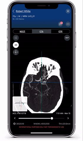 Viz.ai is the leader in AI-powered care coordination and has accelerated the time-to-notification of the treatment team by 73 percent and time-to-treatment by percent. The Viz Platform is now utilized in over 850 hospitals across the U.S. and Europe and touches almost two patients every minute.  Shown here is a Viz LVO module viewer. High resolution full 3D viewing enables dynamic visualization of the anatomy for faster decision making and improved care coordination.