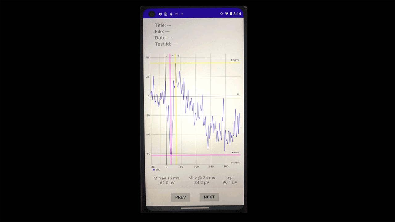 Evoq Technologies “Seeing Change in a Flash” Smartphone Retinal Testing