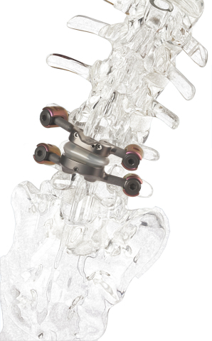 TOPS is a motion preserving solution for 350,000 patients worldwide who suffer from degenerative spondylolisthesis and lumbar spinal stenosis who either undergo fusion surgery each year or persevere with these debilitating diseases for fear of rigid spinal fixation. TOPS recently won Breakthrough Device Designation from the U.S. Food and Drug Administration (FDA) and is currently the subject of a pivotal clinical trial under an investigational device exemption from the FDA. (Photo: Business Wire)