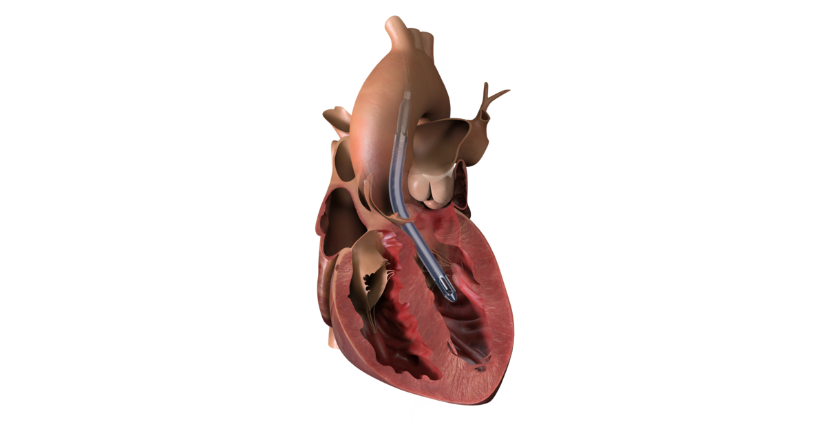 日本と香港でimpella 5 5 Smartassistが承認取得 米国fdaがimpella Btrの患者さん使用への初回アーリーフィージビリティスタディの条件付き治験用医療機器に対する適用免除 Ide を付与 Business Wire