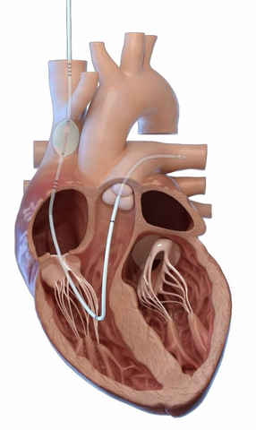 The preCARDIA system is placed in the heart to intermittently occlude the superior vena cava. (Graphic: Business Wire)