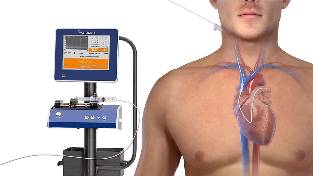 This animation shows how the preCARDIA system is placed, activated and removed.