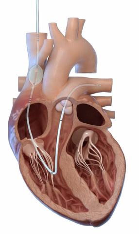 thumbnail The preCARDIA system is placed in the heart to intermittently occlude the superior vena cava. (Graphic: Business Wire)