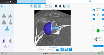 The Equinoxe Planning App (v. 2.0) continues to allow surgeons to plan the placement of glenoid components for aTSA and rTSA. (Photo: Business Wire)