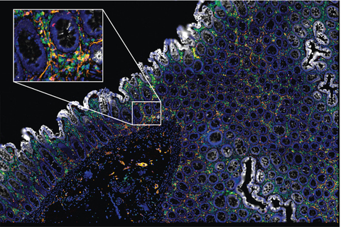 High-plex image of FFPE colorectal tissue stained and imaged with ChipCytometry. Inset shows magnification with subcellular resolution. (Photo: Business Wire)