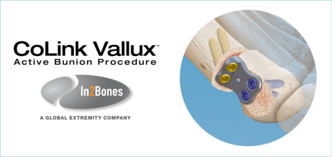 CoLink Vallux™ Active Bunion is a new, minimally invasive, joint-sparing correction technique for moderate to severe bunions. Surgeons can correct joint alignment in multiple dimensions while avoiding any restriction of the joint space and not fusing the joint at the midfoot. The Active Bunion implant -- a zero-prominence CoLink Vallux™ plate and a choice of non-locking and variable angle locking screws -- and guided translational osteotomy technique improve on traditional open fixation approaches as well as newer bunion surgeries by providing surgeons with a simpler, faster procedure that can address over 90 percent of bunion cases. Active Bunion’s small incision of 1-2 cm and technique as a whole reduces internal scarring compared with other bunion corrections, decreasing typical postoperative stiffness, pain, and potential for wound complications. Active Bunion can typically be completed in about 20 minutes, compared to 40-60 minutes for other more invasive and complex corrections. (Graphic: Business Wire)