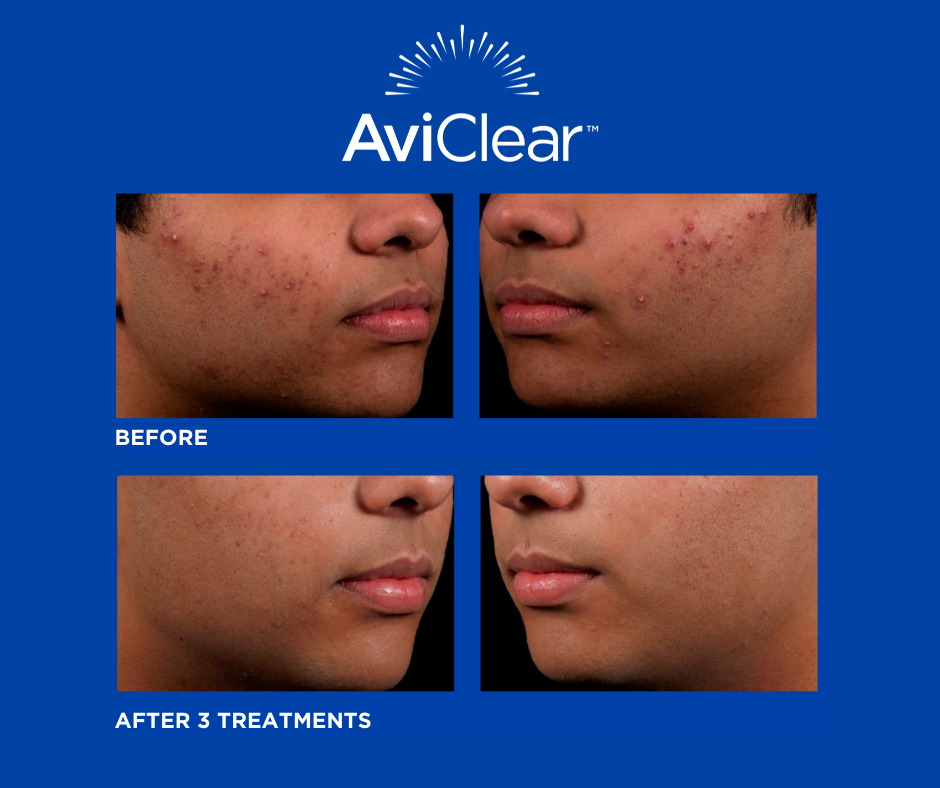 FAQ: How Effective is “Clean & Clear” as an Acne Treatment?