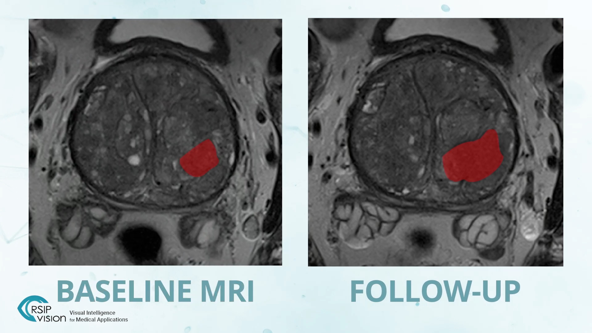 New AI Tool for Prostate MRI Analysis from RSIP Vision performs segmentation of the prostate, its sub-sections, and lesions.