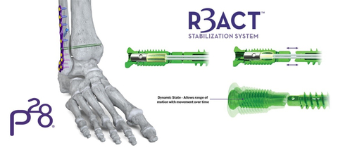 R3ACT™ Stabilization System (Graphic: Business Wire)