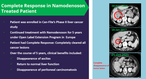 Radiological data show the disappearance of tumor lesions from a patient treated with Namodenoson who had advanced disease and fully recovered. (Graphic: Business Wire)