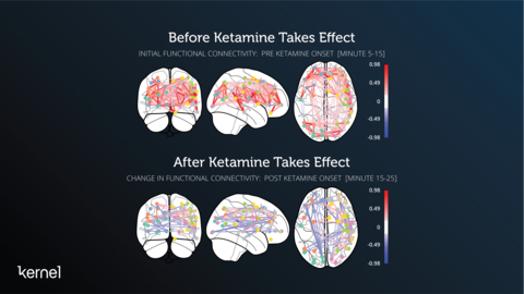 Top images: Johnson’s absolute functional connectivity for minutes 5-15 after he received the 57.75mg intramuscular injection of Ketamine. Bottom images: Johnson’s relative functional connectivity changes after the Ketamine took effect starting at minutes 15-25. (Graphic: Business Wire)