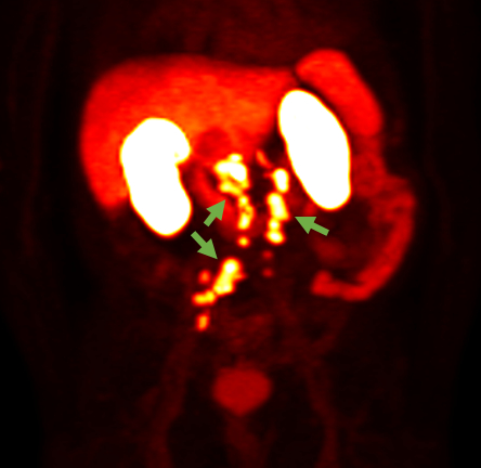 18F-rhPSMA-7.3 PET image showing prostate cancer spread beyond the prostate region. Photo courtesy of Blue Earth Diagnostics