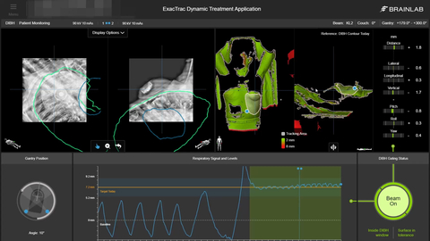 thumbnail The integrated software application verifies correct alignment of external anatomy with surface tracking and internal anatomy with stereoscopic X-Ray imaging at breath hold. (Source: UZ Brussel)