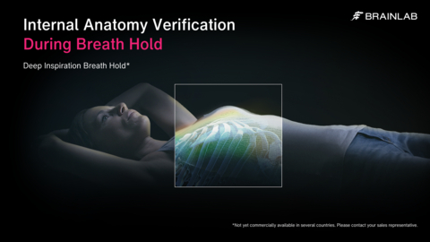 thumbnail Clinicians position and monitor breast radiation therapy patients with the dedicated ExacTrac Dynamic Deep Inspiration Breath Hold workflow that helps ensure the highest quality of care. (Source: Brainlab)