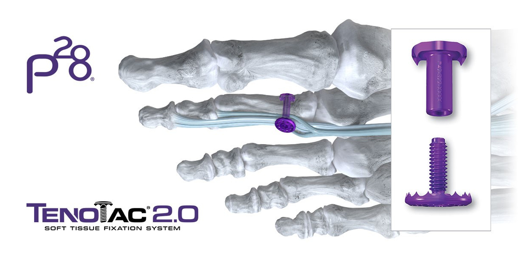 Paragon 28 Launches TenoTac™ 2.0 Soft Tissue Stabilization System 