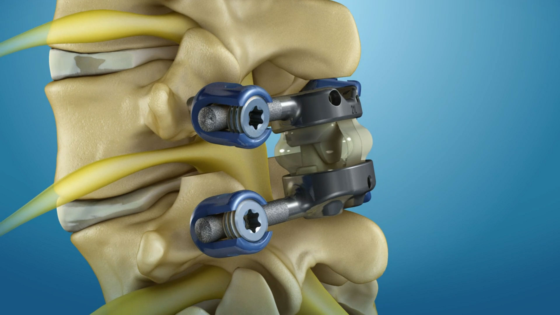 The TOPS System is a dynamic implant designed to stabilize the spine without fusing. The system is an articulating single-level prosthesis affixed to the spine by pedicle screws. Unlike fusion, it allows the spine to maintain mobility, flexibility and range of motion by providing physiologic multiaxial, three-column stabilization.