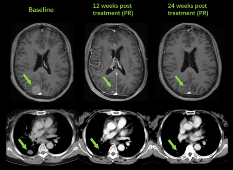 Patient Case: a TKI-naïve ROS1-positive NSCLC patient with brain metastasis showed near-complete disappearance of target lesions in brain (upper panel) and lung (lower panel) after 12-week treatment of taletrectinib 600mg QD (Photo: Business Wire)