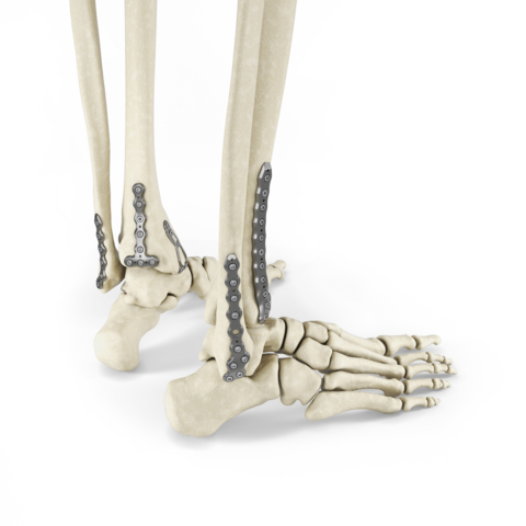 Covered From All Angles. Enovis, formerly branded as DJO, introduces the new Arsenal Ankle Plating System. 37 Plates within nine plate families address both tri-malleolar and intra-articular fracture patterns. (Photo: Business Wire)