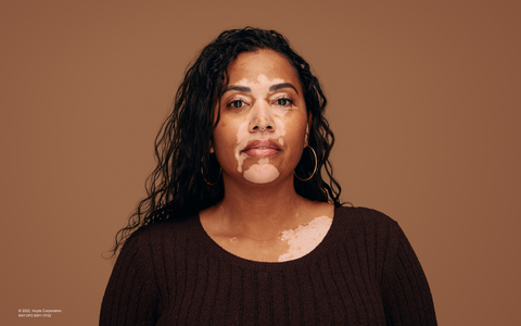 Image of person with nonsegmental vitiligo (Photo: Business Wire)