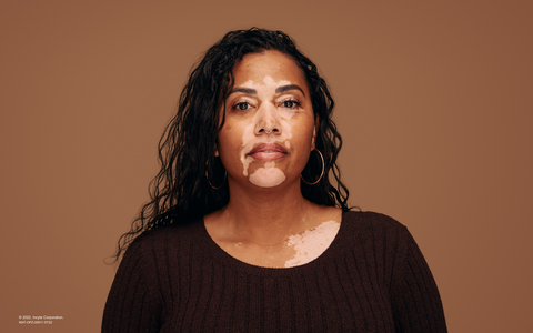 thumbnail Image of person with nonsegmental vitiligo (Photo: Business Wire)