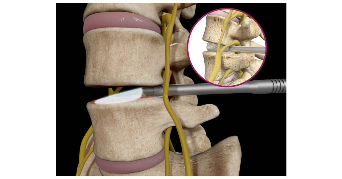 Spineology® Launches First Fully Endoscopic, SingleTubular Retractor