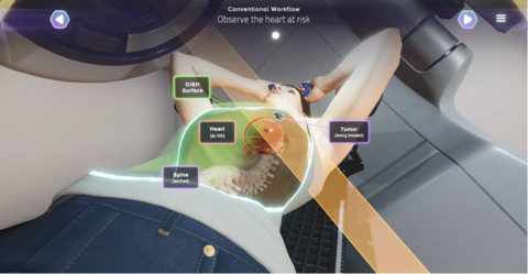With Brainlab ExacTrac Dynamic® Deep Inspiration Breath Hold module, clinicians are able to correlate internal and external anatomy, revealing any misalignment that may otherwise remain undetected. (Source: Brainlab)