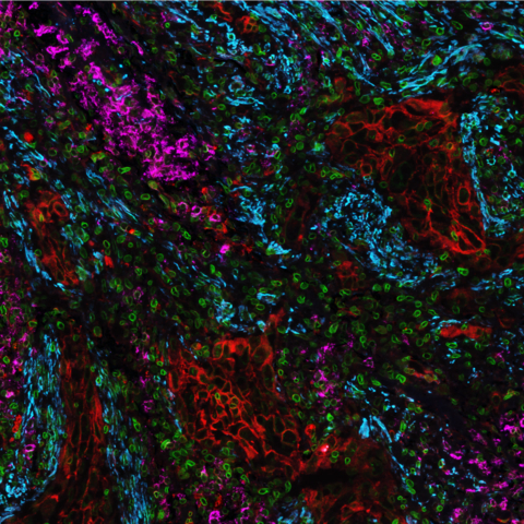 FS Human Lung Carcinoma - 4 markers displayed out of a 32plex, CD38 (magenta), NaKATPase (red), LaminB1 (green), aSMA (turquoise), performed on COMET™ [Photo credit: Lunaphore]