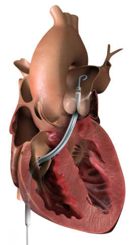 thumbnail Impella RP with SmartAssist is the only right heart pump equipped with dual-sensor technology to assist with pump management. (Graphic: Business Wire)